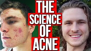 Finally, The Science Of Acne! | ALCOHOL, HIGH SUGAR, DAIRY, ETC!