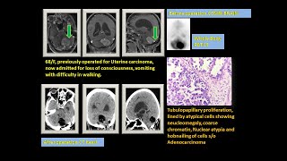 Paramedian suboccipital craniotomy \u0026  Microsurgical excision of cerebellum tumor| Brain metastasis