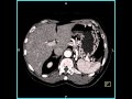 Abdomen: Kidney: Liver: 3D reconstructions demonstrate a solitary right kidney(5 of 6)