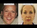 Are You Ready For A Facelift Surgery? - Dr. Julian De Silva