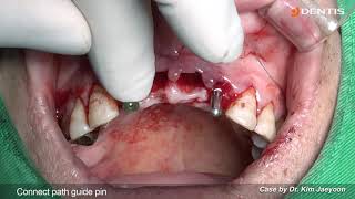 [DENTIS Implant] Upper anterior immediate implants placement and loading with socket preservation