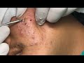 cystic acne extraction this week blackheads removal 0028