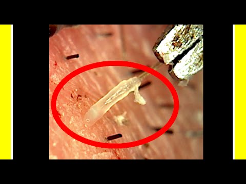 What removes hair from the root?