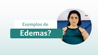 Principais exemplos de edemas - VITALTAPE