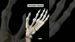 Trigger Finger surgery#triggerfinger#triggers   #physicaltherapy #handanatomy #anatomy_physiology