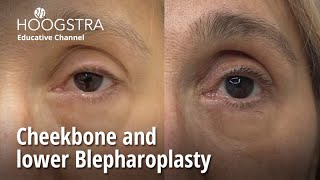 Cheekbone and lower Blepharoplasty - 23107