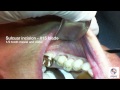 extraction of tooth 19 with ridge preservation grafting