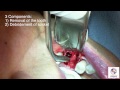 extraction of tooth 19 with ridge preservation grafting