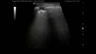 subpleural consolidation