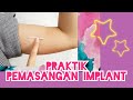 Praktik pemasangan Implan