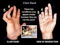 Claw Hand, Ulnar Claw Hand - Everything You Need To Know - Dr. Nabil Ebraheim