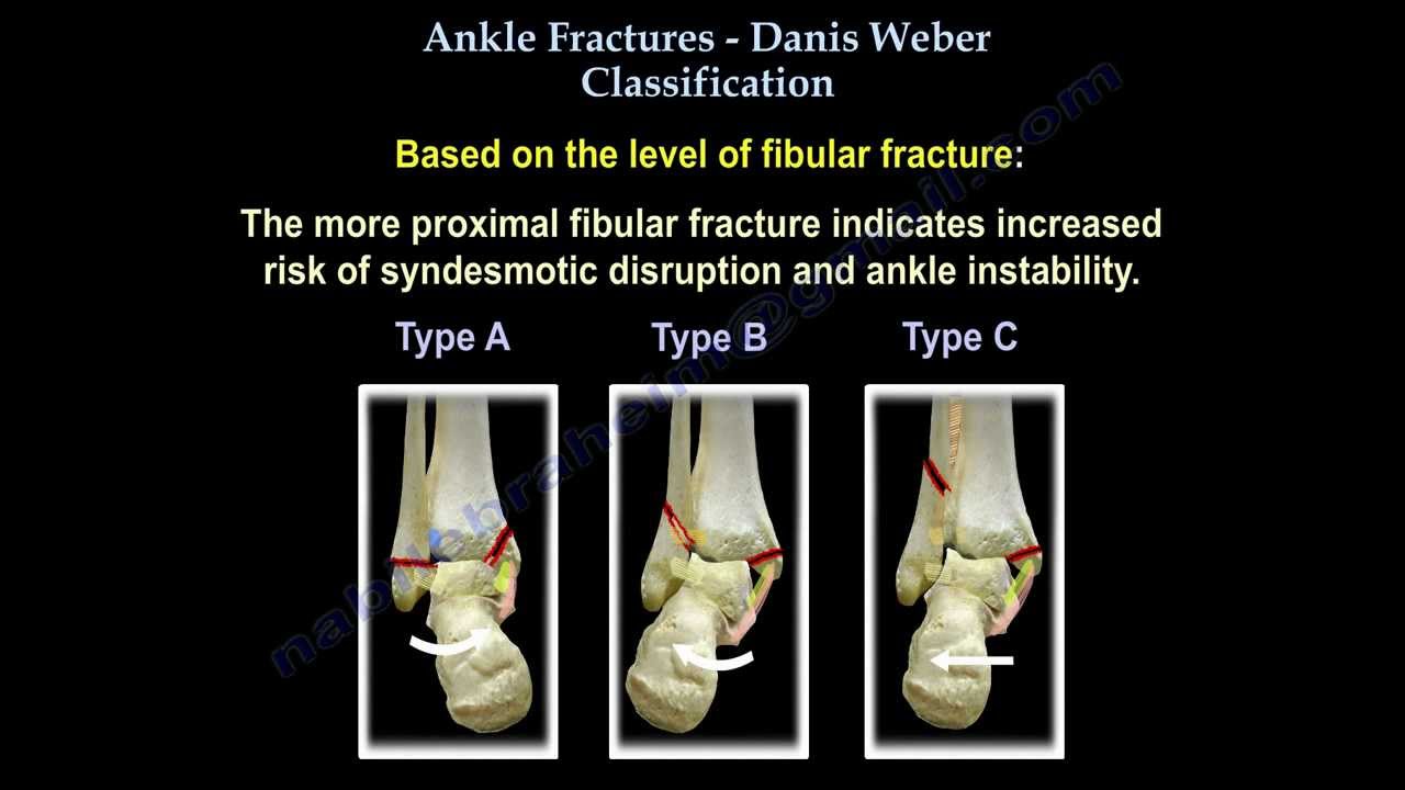 Ankle Fractures Danis Weber Classification - Everything You Need To ...