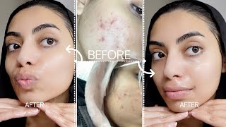 My Night Time 'GLASS SKINCARE ROUTINE' | Acne Journey | TRETINOIN ♡