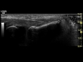 2 Tratamiento con la técnica EPI de una epicondilitis crónica