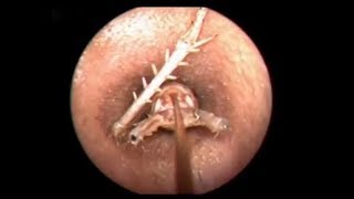 Milia Removal The first person to clean earwax after 30 years of life [01]