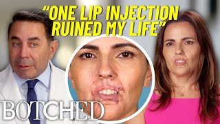 Monica Lost Her ENTIRE Upper Lip After ONE Round of Bad Lip Filler?! (Before & After) | Botched | E!
