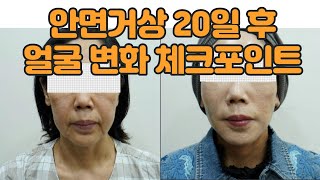 안면거상 20일 후 주름이 쫙 펴진 얼굴 변화 체크포인트