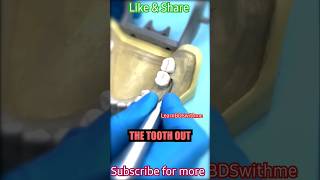 Tooth extraction procedure