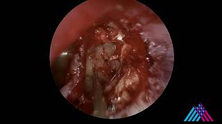 Revision Stapedectomy for otosclerosis