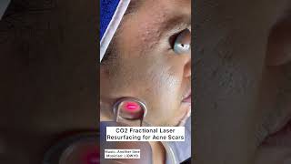 CO2 Fractional Laser Resurfacing for Acne Scars #shorts