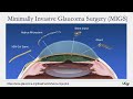 Understanding Glaucoma Diagnosis, Treatment, and Research on the Horizon