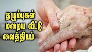 Treat Your Accident Marks in Home ||  தழும்புகள் மறைய வீட்டு வைத்தியம் - Tamil Health Tips