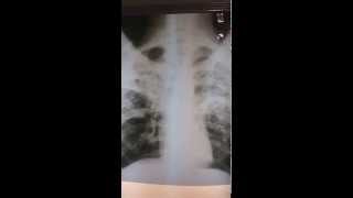 Tuberculosis