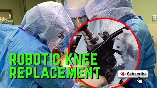 ROBOTIC KNEE REPLACEMENT OPERATING ROOM ACTION