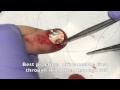 Fingernail Bed Repair, traditional method