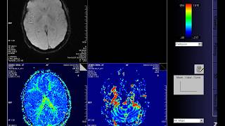 Perfusion MRI