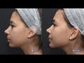 Tratamiento de armonización facial by Dr. Esquivel | Clínicas Esquivel