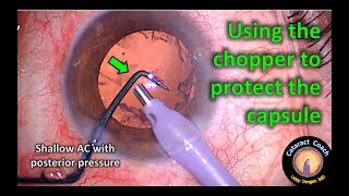 use the chopper to protect the capsular bag during cataract surgery