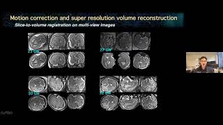 Advanced fetal brain MRI processing and analysis: Methods and Applications