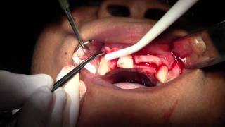 Maxillary Bone Grafting #7-8-10 Sites, Flap Design \u0026 Reflection