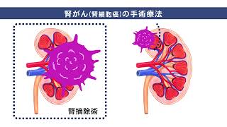 泌尿器科専門医が解説！！腎がんとは？その治療とは？