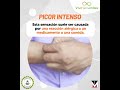 ¿Cuál es el síntoma más molesto de la urticaria?