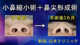 【鼻整形】小鼻縮小＋鼻尖形成の変化@dryamamotoclinic