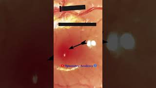 Normal fundus with foveal reflex present | Normal fundus | Normal Retina |  Short Video 115