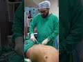 360 Abdominal Liposuction | Liposuction  | Liposuction  cost #shortvideo #shots