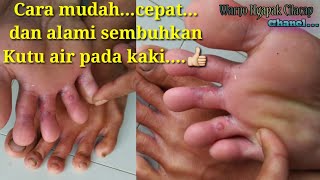 Ini Bahaya Nya Kutu Air Pada Kaki