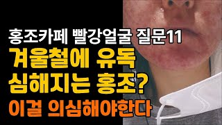 #자미원 #안면홍조 #온도홍조  겨울철에 유독 심해지는 홍조? 클렌저도 안했다면 이걸 의심해야