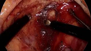 Laparoscopic abdominoperineal resection following revascularization of iliac vessels