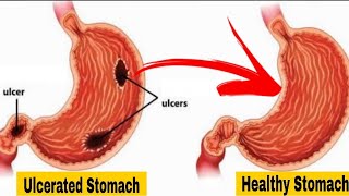 Stomach Ulcer - Causes And Natural Treatment | Dr. Vivek Joshi