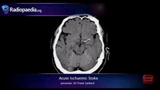 Stroke: Acute infarction - radiology video tutorial (CT, MRI, angiography)