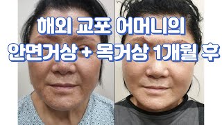 해외 교포 어머니의  안면거상 \u0026 목거상 1개월 후