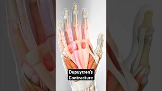 Dupuytren's contracture (Viking Disease) (3D Animation)