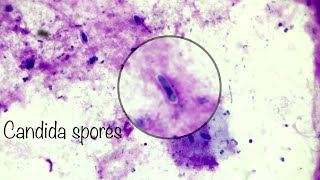 Candida spores in cytology