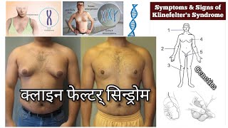 Klinefelter Syndrome | Klinefelter Syndrome causes symptoms in hindi