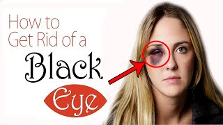 How to Get Rid of a Black Eye Safely | Home Remedies for Black Eye Treatment