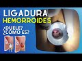 🧶 ¿Qué es la 𝐋𝐈𝐆𝐀𝐃𝐔𝐑𝐀 de Hemorroides, en quién se puede realizar y cómo se hace?